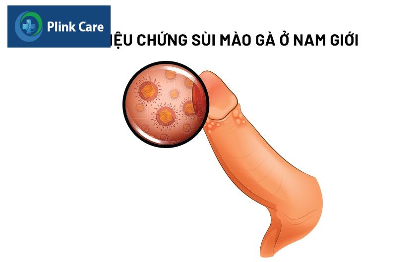 hình ảnh sùi mào gà ở nam giới