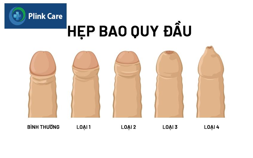 khi nào cần cắt bao quy đầu