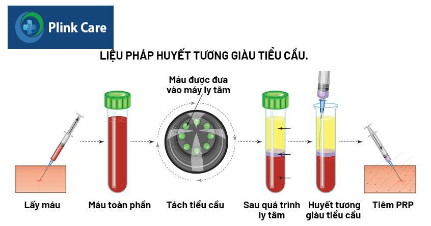 liệu pháp tiêm prp