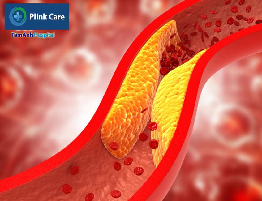nguyên nhân gây bệnh động mạch vành