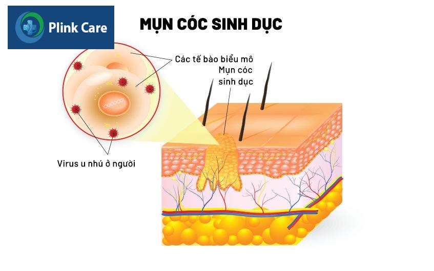 nguyên nhân gây sùi mào gà