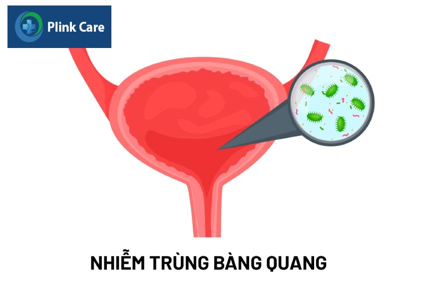bàng quang nhiễm khuẫn
