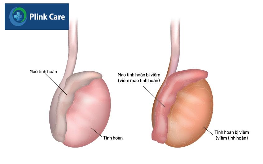 như thế nào là viêm mào tinh hoàn