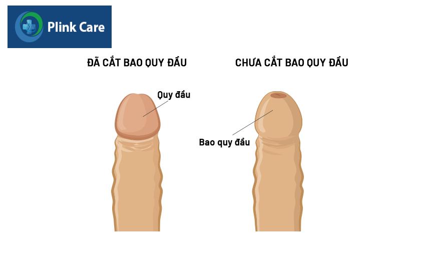 phân biệt bao quy đầu