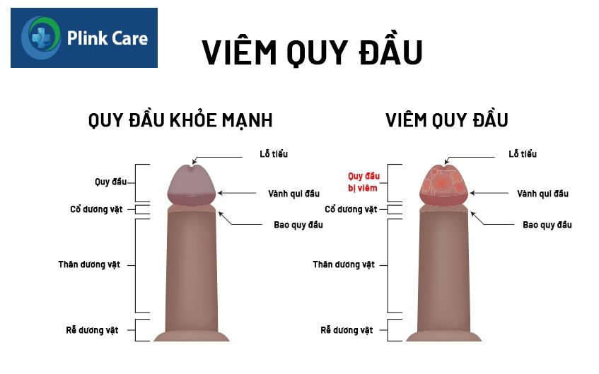 phân biệt viêm đầu dương vật và viêm bao quy đầu