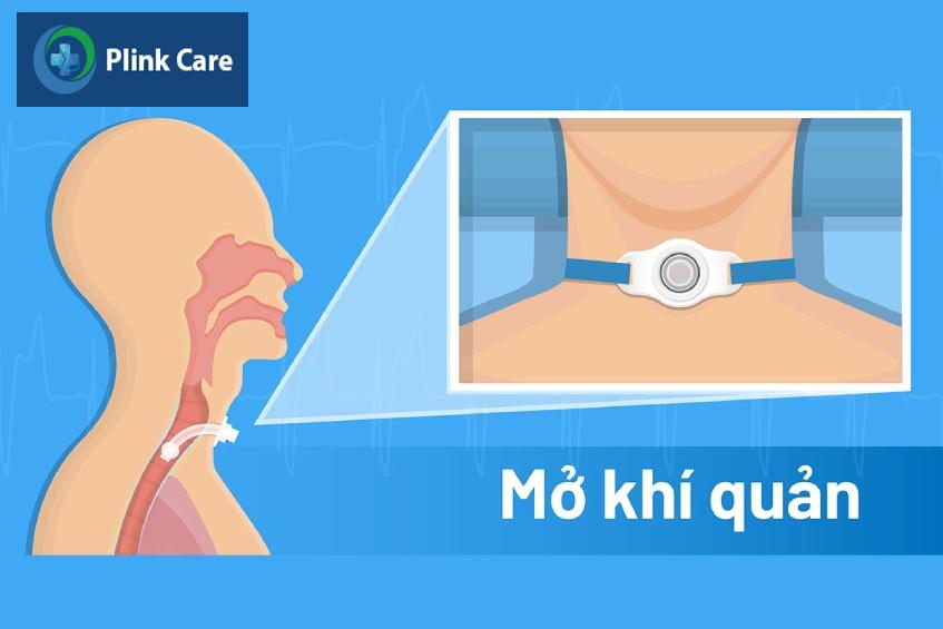 Phẫu thuật mở khí quản
