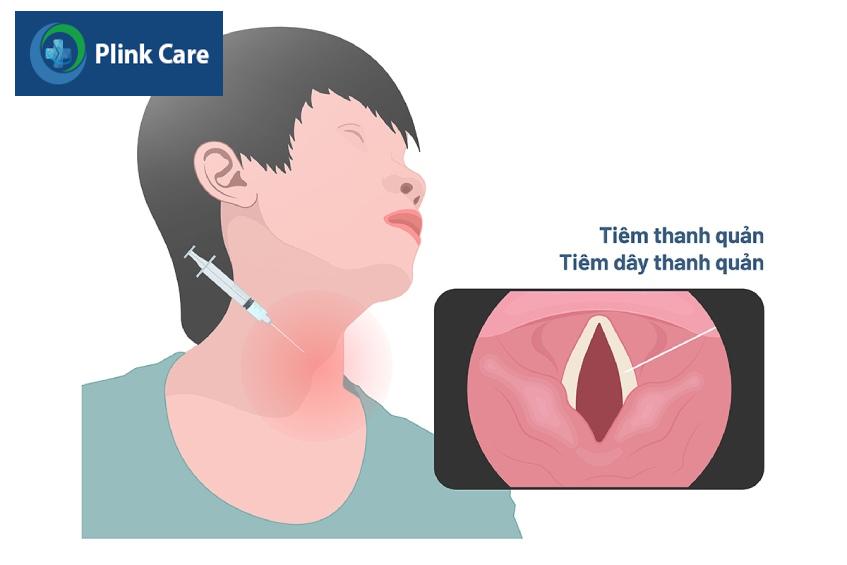 tiêm dây thanh