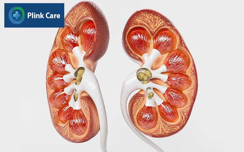 sỏi đường tiết niệu