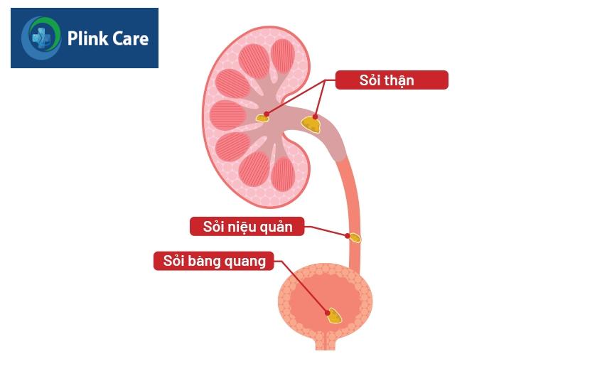 sỏi gai tiết niệu