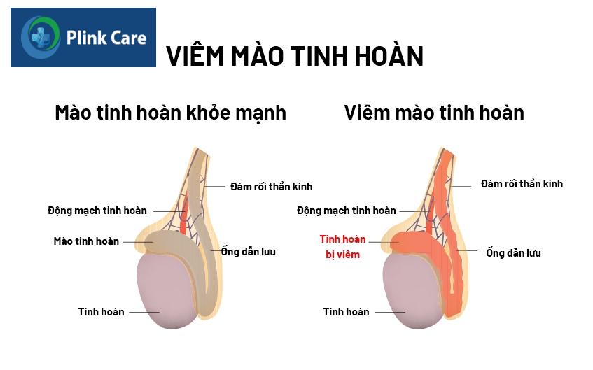 sự khác biệt giữa viêm mào tinh hoàn và viêm tinh hoàn