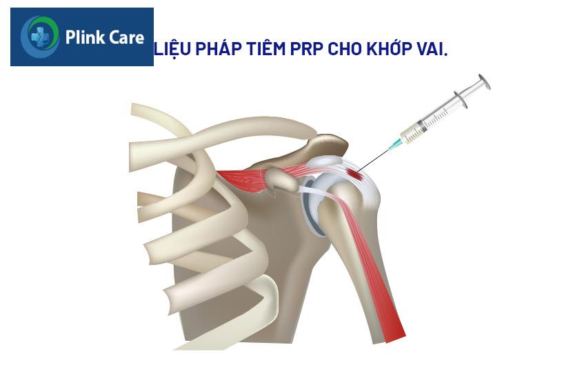 tiêm prp cho khớp vai
