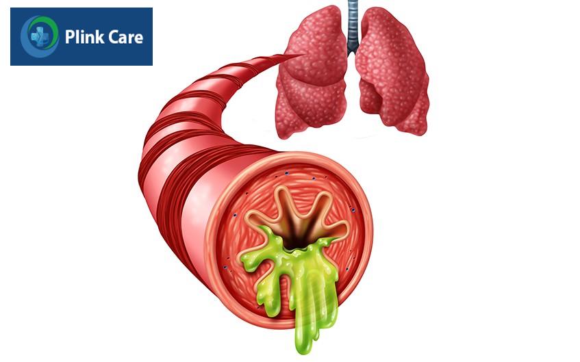 Tiểu phế quản bị sưng, tích tụ dịch nhầy