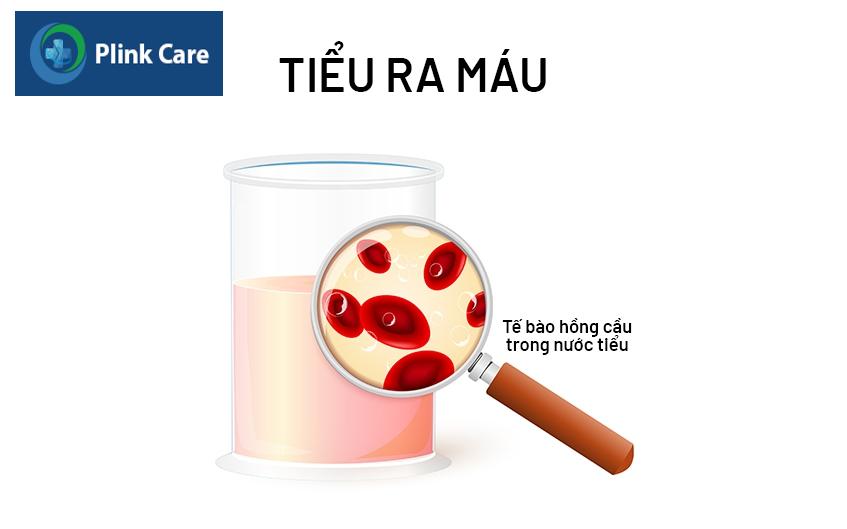 tiểu ra máu ở nữ là gì