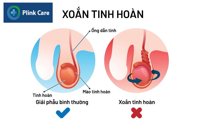 tinh trạng xoắn tinh hoàn