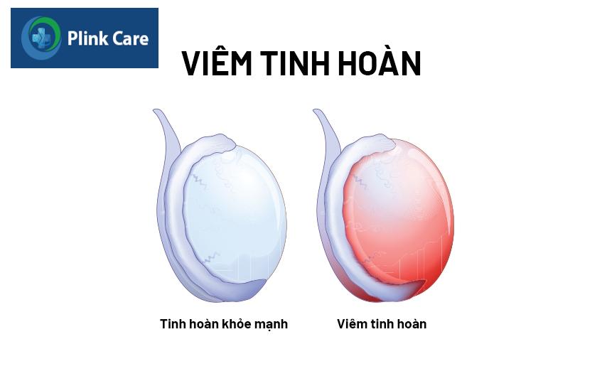 tổng quan bệnh viêm tinh hoàn