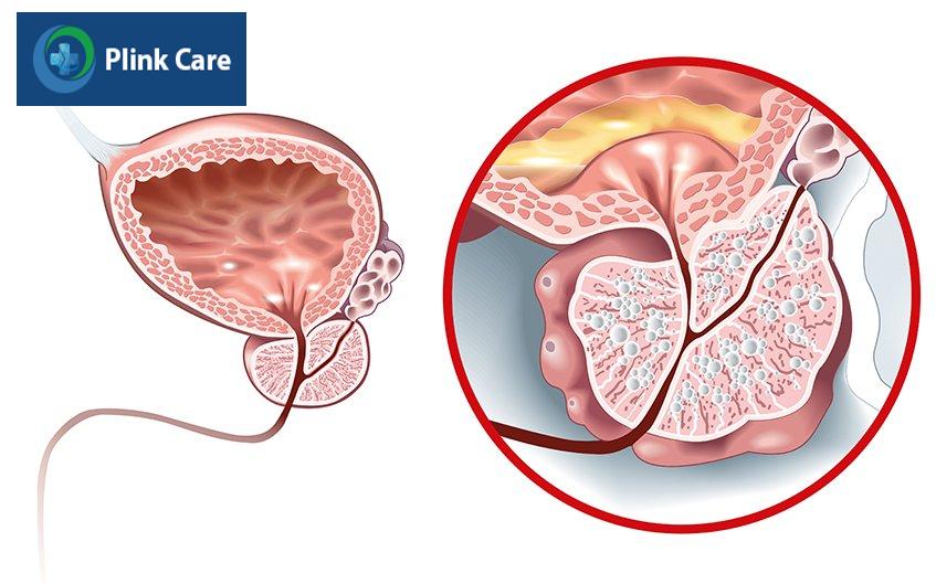 tổng quan về bệnh viêm tuyến tiền liệt