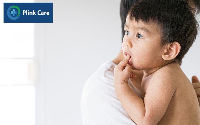 Trẻ bị phát ban toàn thân do sởi