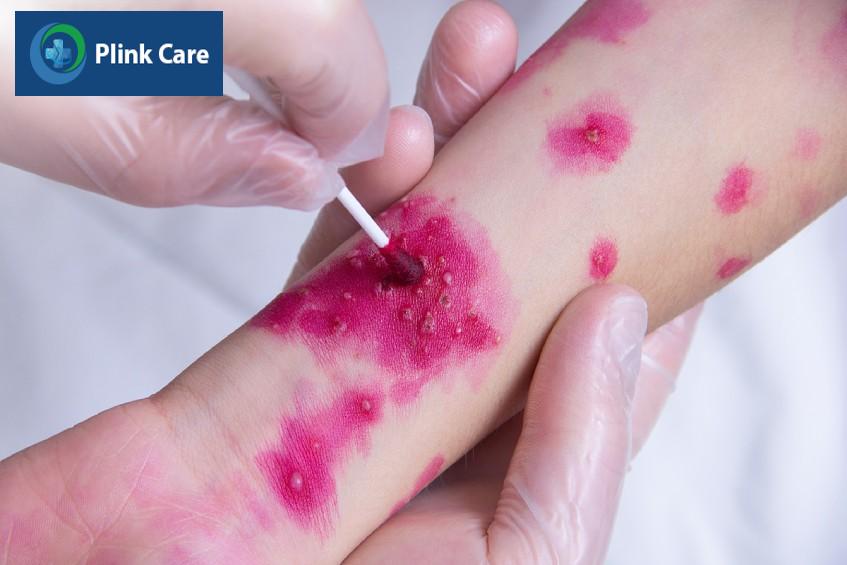 Trẻ bị thủy đậu cần được bôi thuốc theo chỉ định của bác sĩ