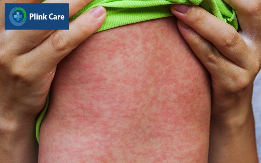 Trẻ phát ban toàn cơ thể do sởi