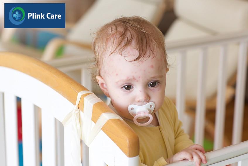 Trẻ xuất hiện nhiều mụn nước trên cơ thể