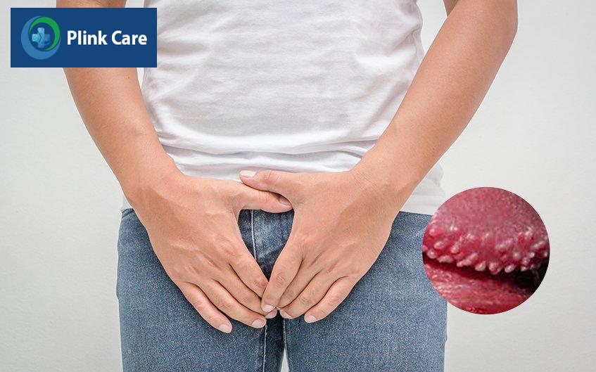 triệu chứng chuỗi hạt ngọc dương vật