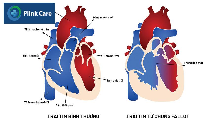 tứ chứng fallot là một dạng tim bẩm sinh có tím