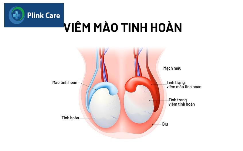 viêm mào tinh hoàn có tự khỏi không
