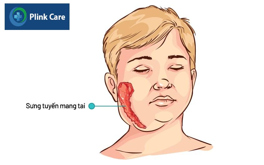 Virus quai bị xâm nhập khiến tuyến mang tai sưng to
