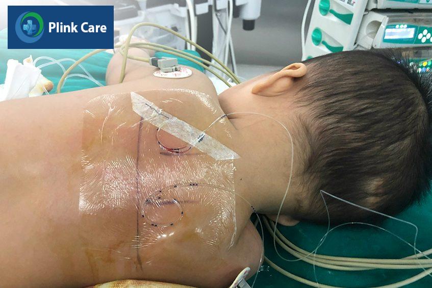 Catheter ESP