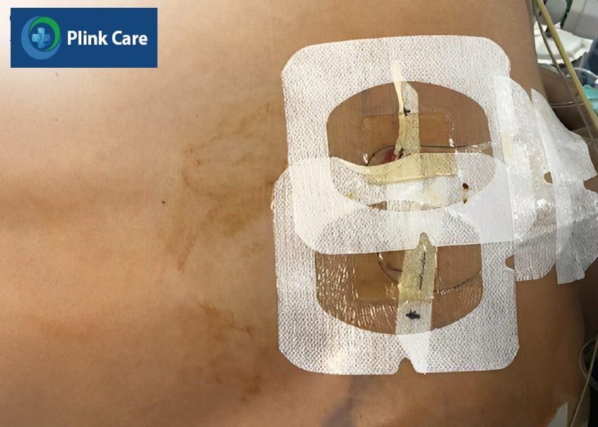 Catheter ESP trên người lớn trong phẫu thuật tim hở.