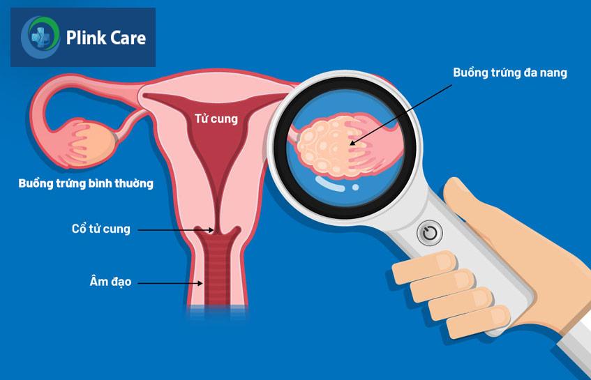 hội chứng đa nang buồng trứng
