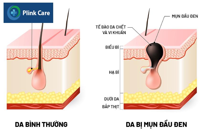 tuyến bã nhờn hoạt động mạnh