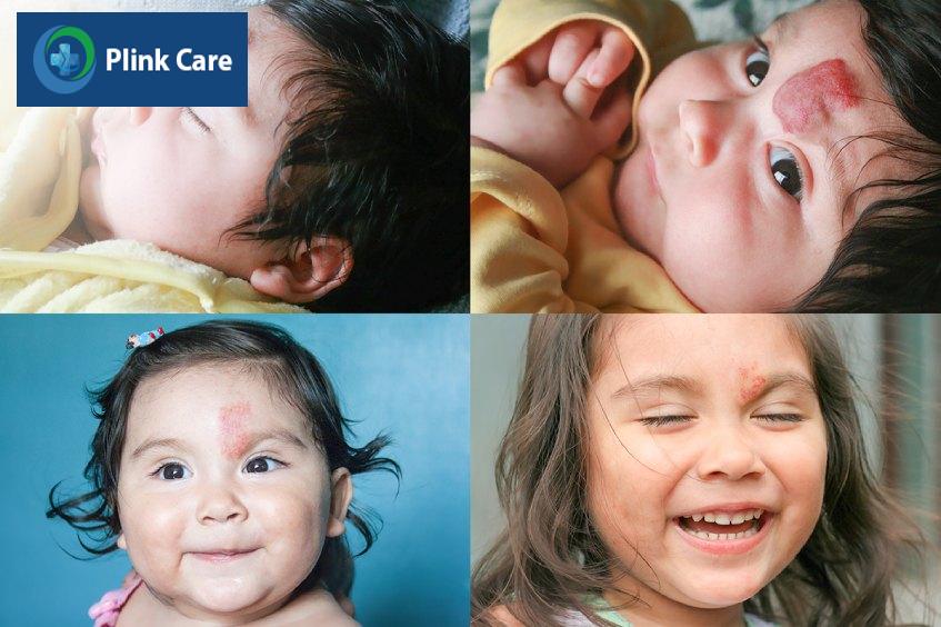 Bé gái bị u máu sau 1 khoảng thời gian điều trị