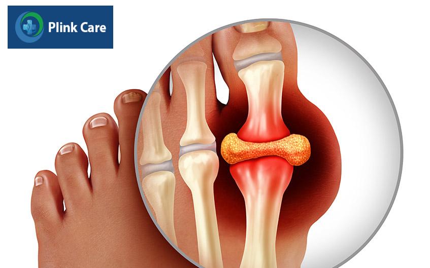 bệnh gout có chữa được không