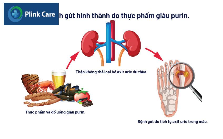 bệnh gút được hình thành