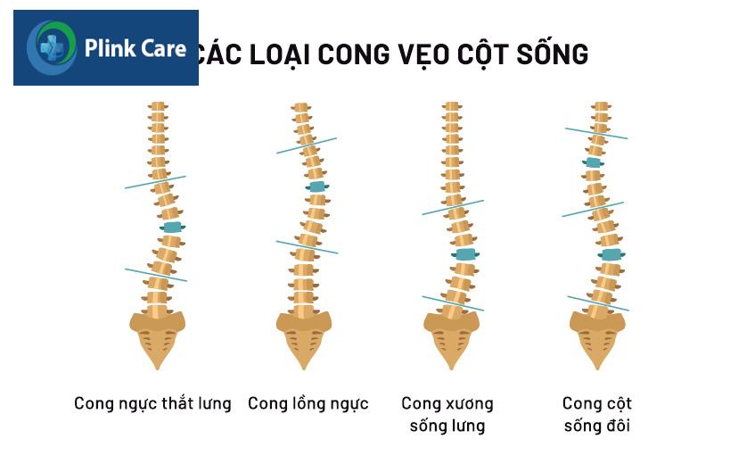 các dạng cong vẹo cột sống