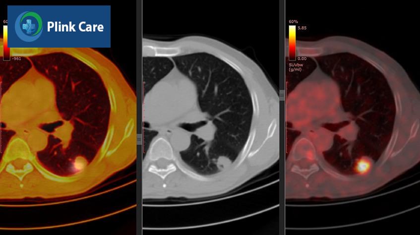 chụp pet/ct để làm gì