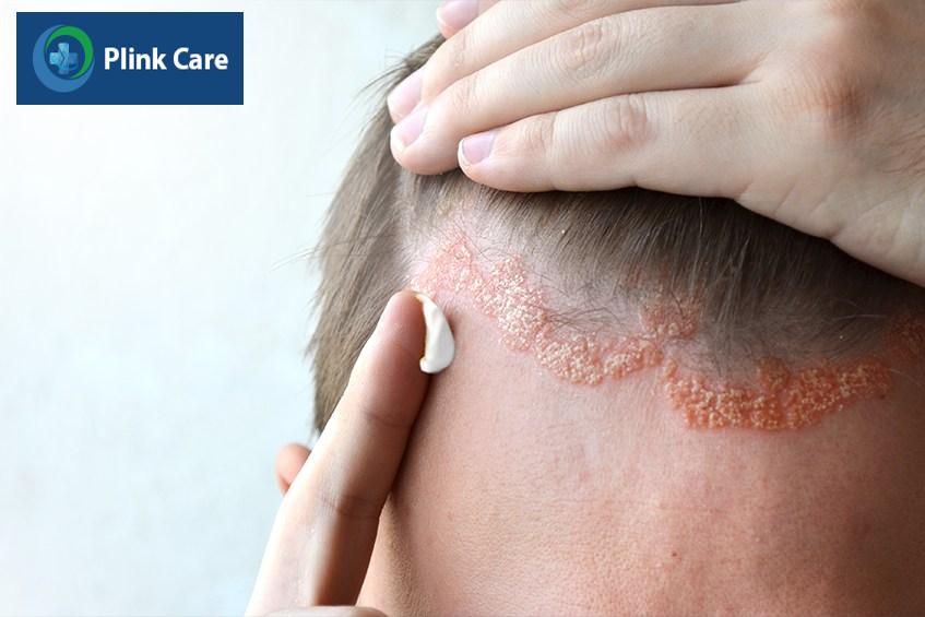 dấu hiệu bệnh vảy nến