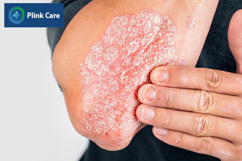 đối tượng nguy cơ mắc bệnh