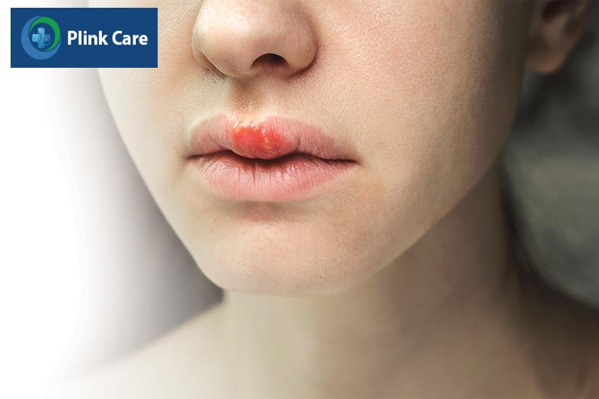 herpes simplex là gì