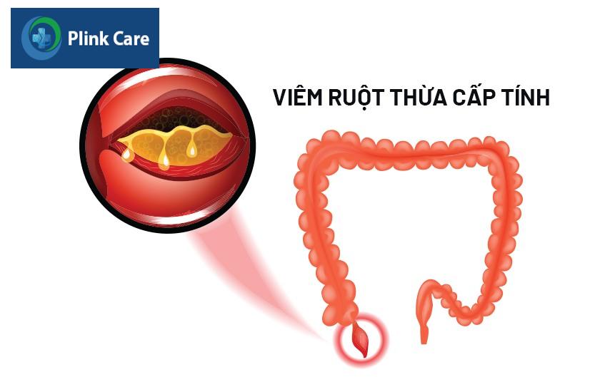 Viêm ruột thừa cấp tính xảy ra do lòng mạch bị tắc nghẽn