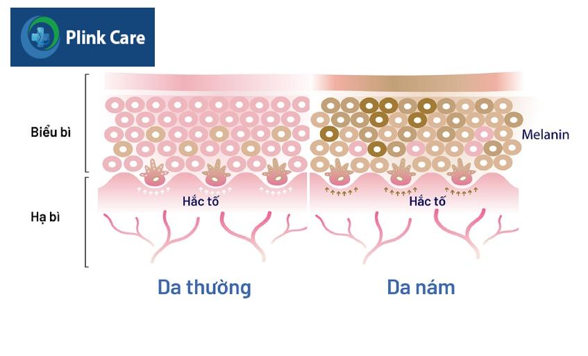 Rối loạn nội tiết tố làm mất cân bằng hormone