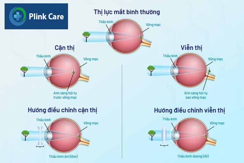 Tật khúc xạ là gì?