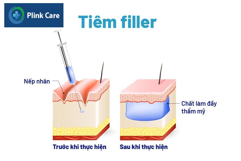 tiêm filler