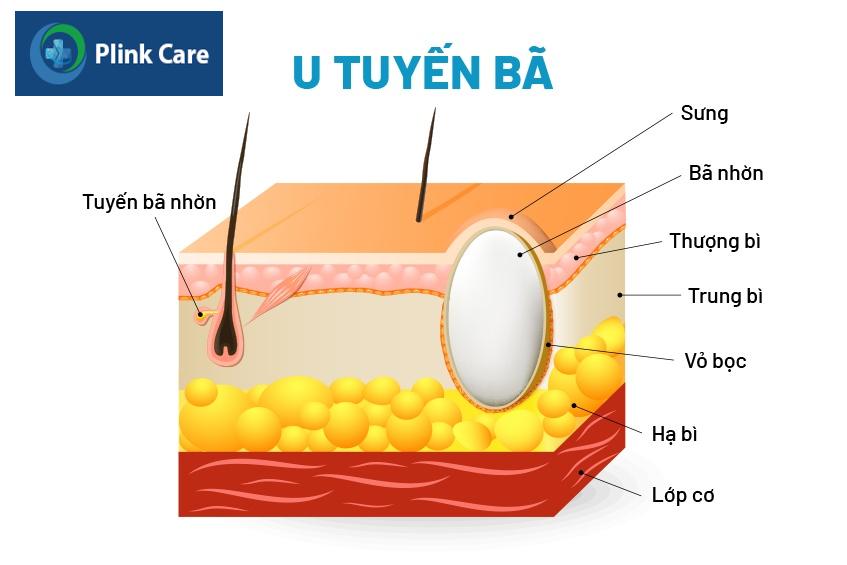 u nang bã đậu là gì