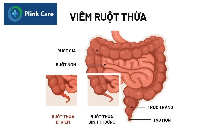 vị trí đau ruột thừa