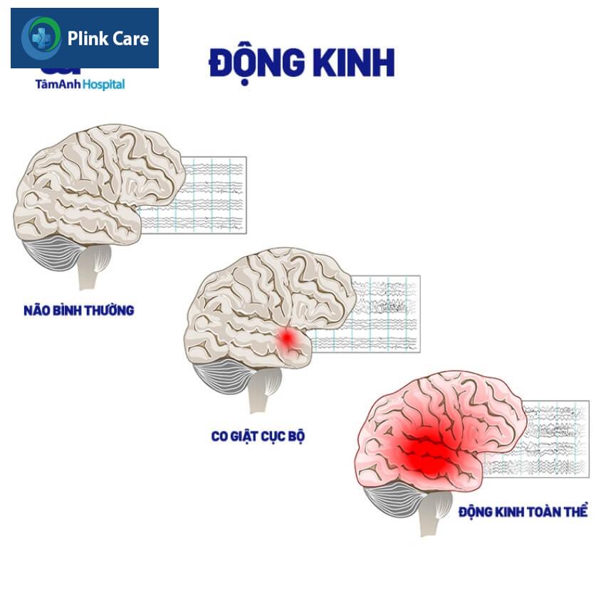 bệnh động kinh gây co giật
