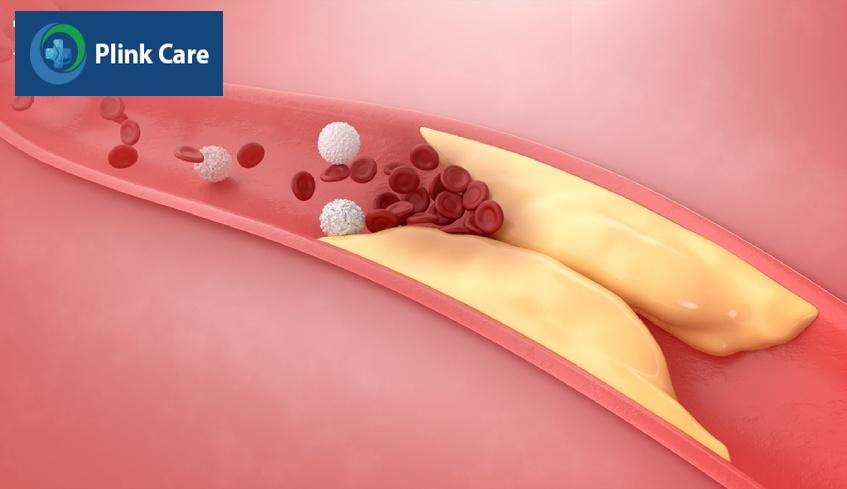 Béo phì có mức cholesterol trong máu cao