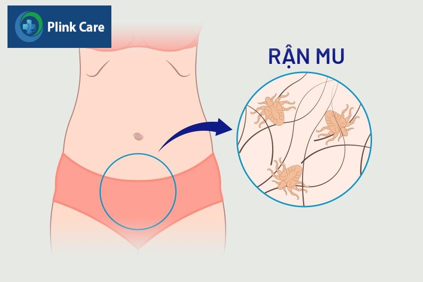cách ngăn ngừa bệnh rận mu