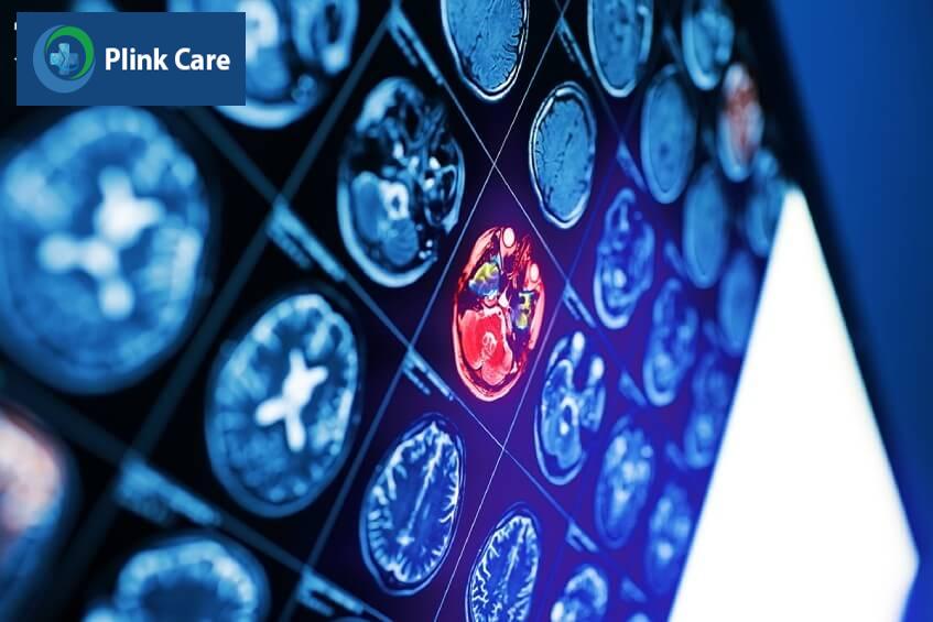 chẩn đoán phân loại u não